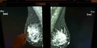 Google Health's AI can spot breast cancer missed by human eyes