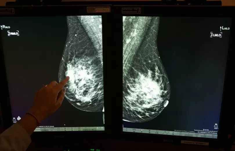 Google Health's AI can spot breast cancer missed by human eyes