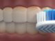 Plaque Identifying Toothpaste May Prevent Heart Attacks and Strokes
