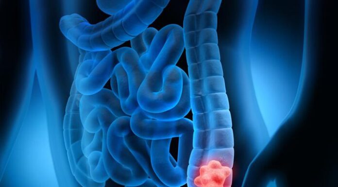 Colon and rectal cancer cases are going up among people younger than age 50, researchers say